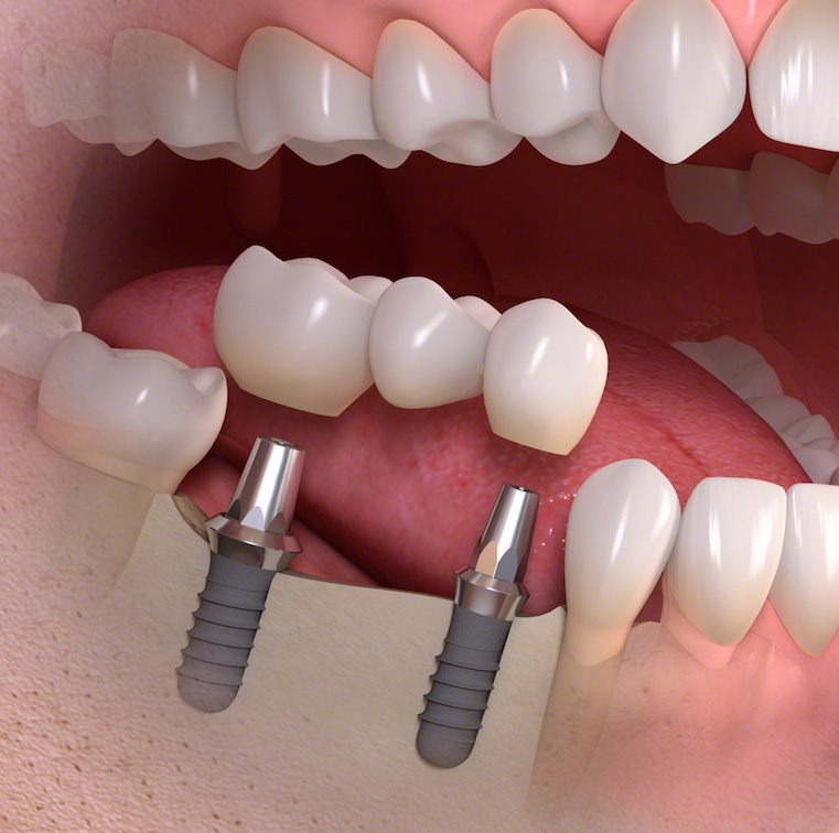 Implant supported multi tooth treatment