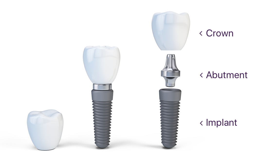 The Parts Of A Dental Implant